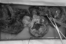 Người phụ nữ có khối u buồng trứng chứa toàn tóc, răng