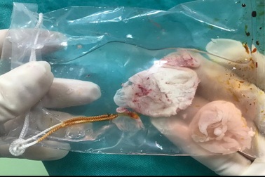 Hay ăn tiết canh, rau sống, người đàn ông có ổ sán não khổng lồ gây liệt nửa người