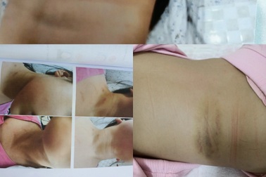 Nghi án hai cháu bé bị bố dượng bạo hành ở Hà Nội