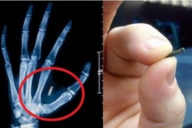 Bác sĩ cấy loạt chip điện tử vào tay để thay cho chìa khóa, thẻ ngân hàng…