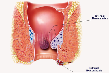Dấu hiệu dễ nhầm lẫn giữa bệnh trĩ và ung thư trực tràng