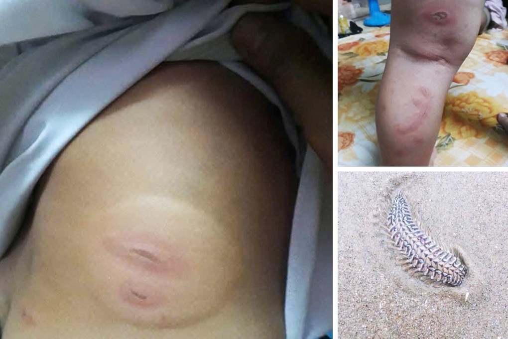 Bệnh viện cảnh báo nóng về thông tin cháu bé bị rết biển cắn nguy kịch - 1