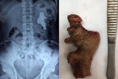 Uống thuốc nam 10 năm, sỏi "đúc khuôn" trong thận