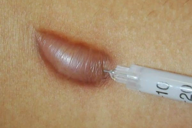 Cô gái ở TPHCM đi cấp cứu sau khi tiêm xóa sẹo tại thẩm mỹ viện "chui"