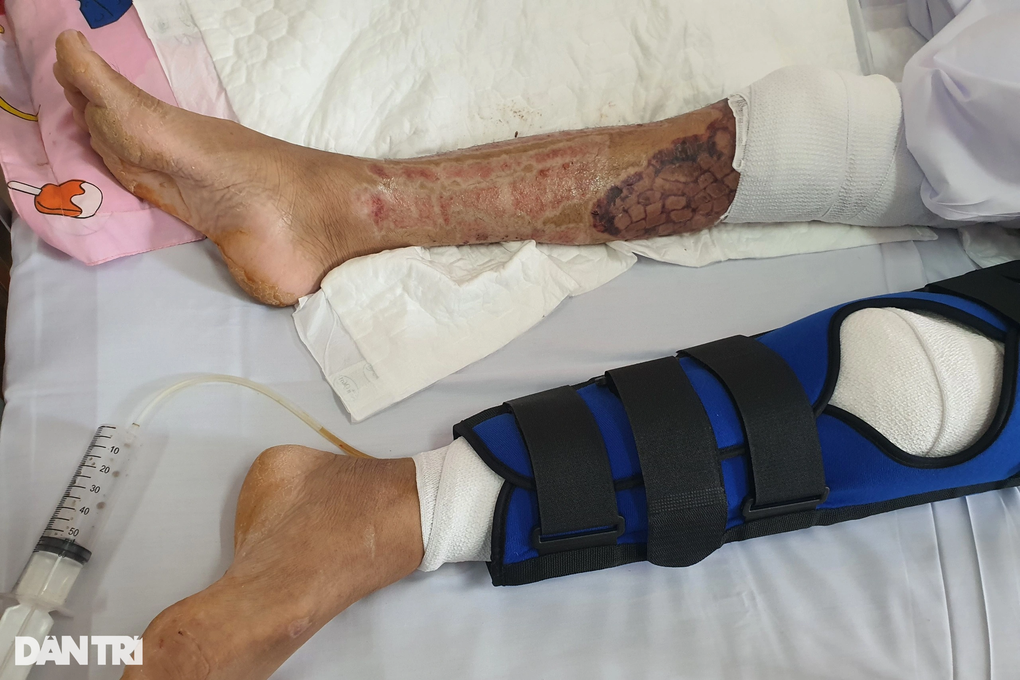 Người đàn ông nghèo hóa thành ngọn đuốc sống được giúp hơn 100 triệu đồng - 2 Người đàn ông nghèo hóa thành ngọn đuốc sống được giúp hơn 100 triệu đồng - 2