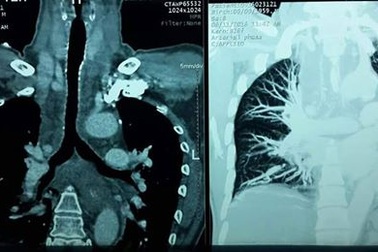 Chuyển bệnh nhân người Đài Loan nguy kịch về nước an toàn