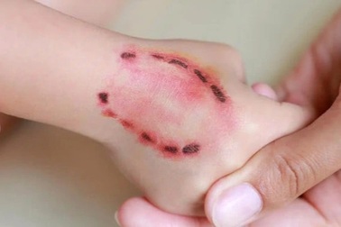 Bé trai bị chó becgie cắn phải nhập viện cấp cứu ở Tây Ninh