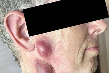 Lây bệnh lạ từ mèo, người đàn ông mọc u trên cổ và mặt