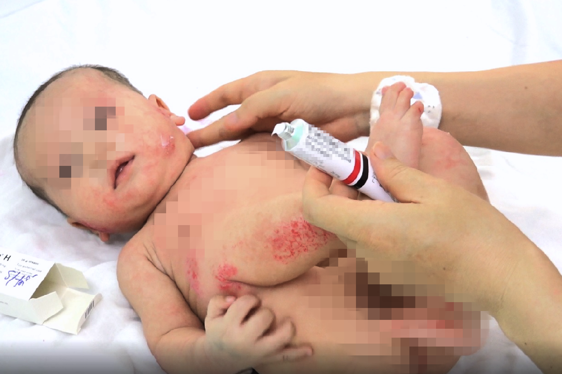 Hàng loạt trẻ bị viêm nhiễm, tổn thương da nặng - 1