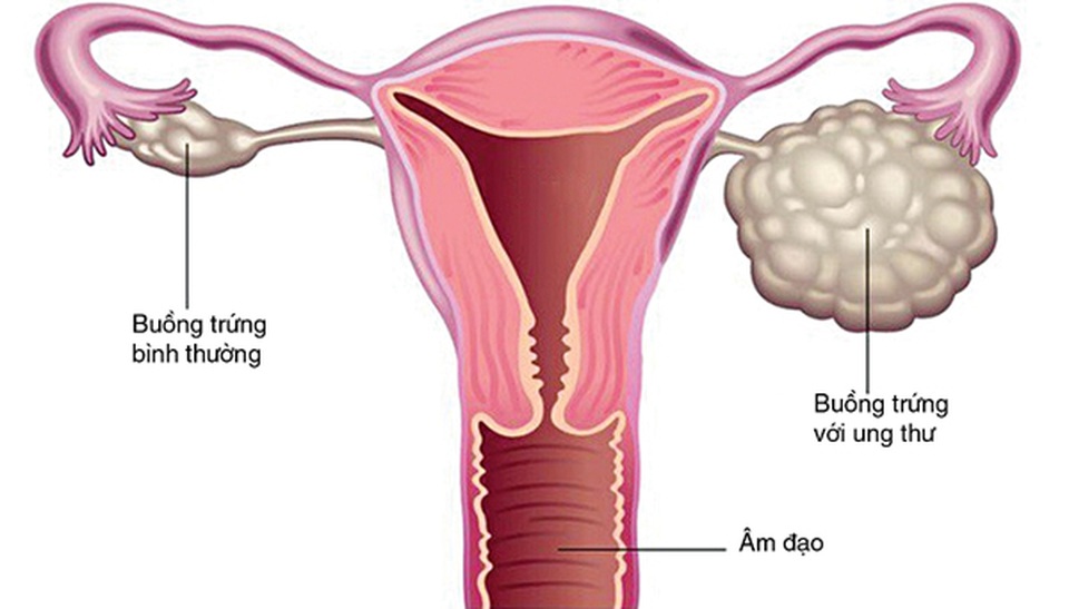 Diễn tiến và triệu chứng của ung thư buồng trứng - 1 Diễn tiến và triệu chứng của ung thư buồng trứng - 1