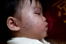 Vụ bé 11 tháng tuổi bị “bầm dập”, bác sĩ yêu cầu cháu bé nhập viện