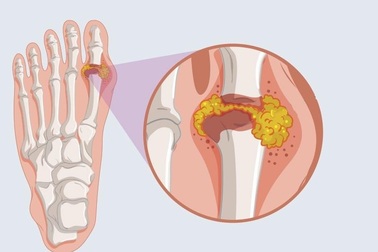 Sản phẩm Hoàng Thống Phong – Giải pháp hữu hiệu cho người bị gút ở ngón chân