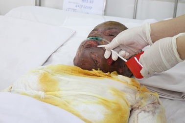 Bếp gas mini phát nổ một nạn nhân bị thiêu sống