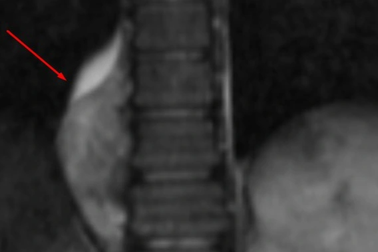 Vào viện điều trị viêm amidan, bé gái 9 phát hiện bị u thần kinh