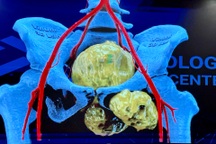 Nam sinh 19 tuổi ở Hà Nội có khối u xương khổng lồ nặng 2kg