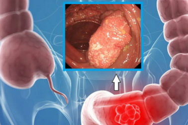 Tránh ung thư đại tràng bắt đầu bằng việc điều chỉnh thói quen