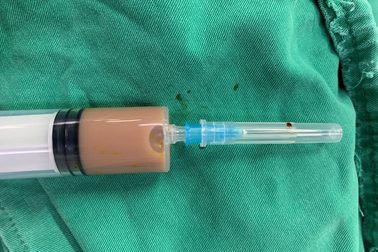 Nửa lít dịch mủ tụ trong người chỉ vì... chữa đau lưng