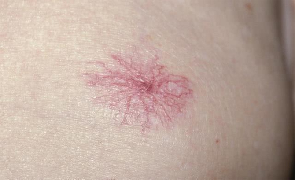 3 biến đổi trên da cảnh báo bệnh ung thư gan - 1 3 biến đổi trên da cảnh báo bệnh ung thư gan - 1