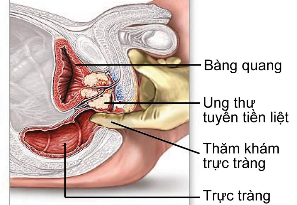 Dấu hiệu ung thư tiền liệt tuyến dễ nhầm với phì đại thông thường - 1 Dấu hiệu ung thư tiền liệt tuyến dễ nhầm với phì đại thông thường - 1