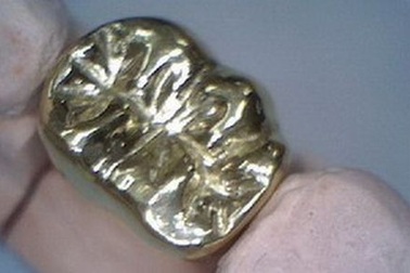 Chế tạo hợp kim titan y sinh cấy ghép trong cơ thể người