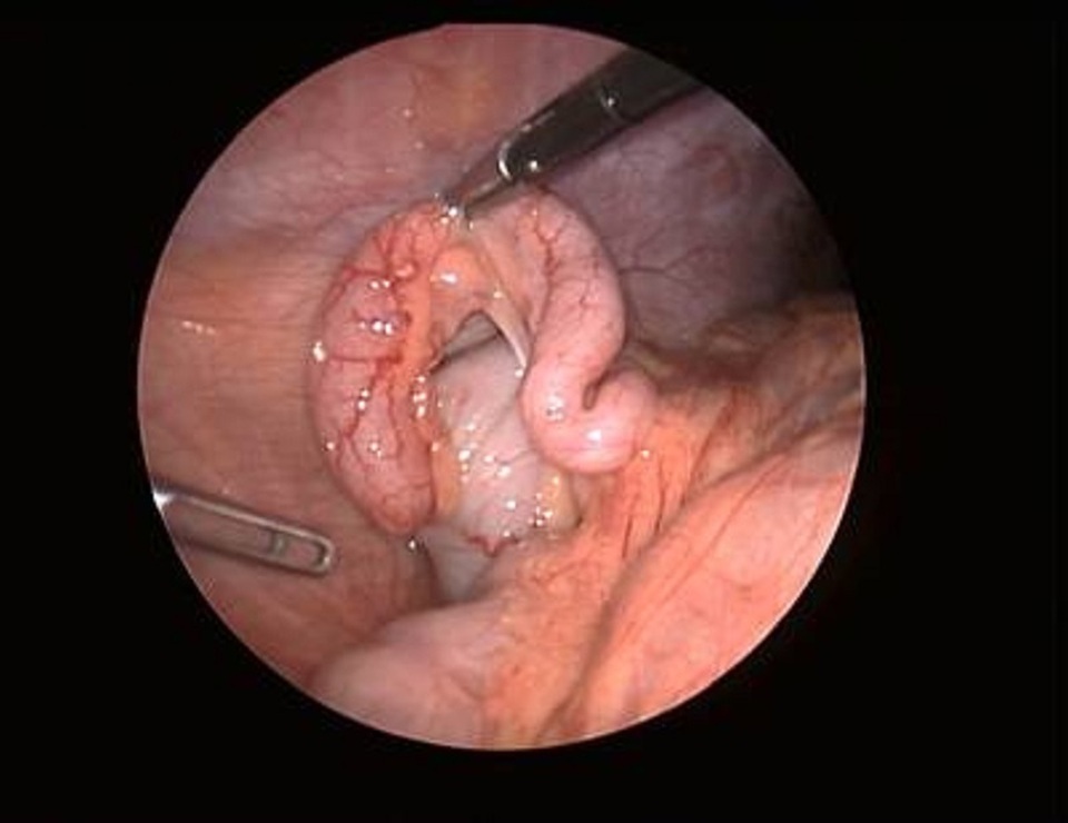 Viêm ruột thừa, bệnh phổ biến nhưng khó nhận biết - 3 Viêm ruột thừa, bệnh phổ biến nhưng khó nhận biết - 3
