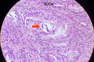 Bệnh viện ở TPHCM bất ngờ phát hiện 4 ca nhiễm giun lươn hiếm gặp