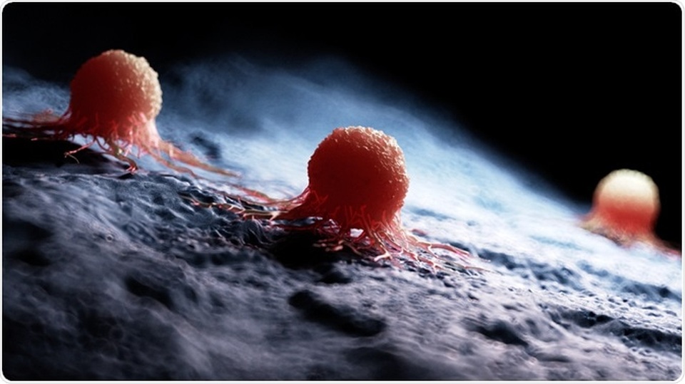 Đâu là loại ung thư phổ biến nhất? - 1
