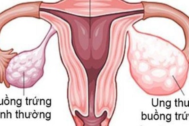 Phụ Lạc Cao EX giúp chị em không còn lo nguy cơ lạc nội mạc tử cung