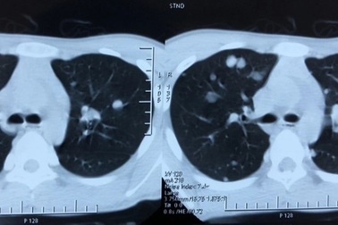 Thiếu niên 15 tuổi ung thư tuyến giáp di căn phổi