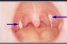 Bé gái 9 tuổi tử vong vì bạch hầu, bệnh nguy hiểm như thế nào?