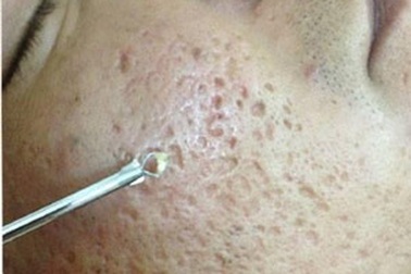 600 khách hàng được trị mụn trứng cá miễn phí 