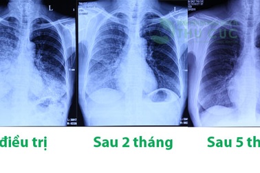 Ung thư phổi dễ bị chẩn đoán nhầm với các bệnh khác
