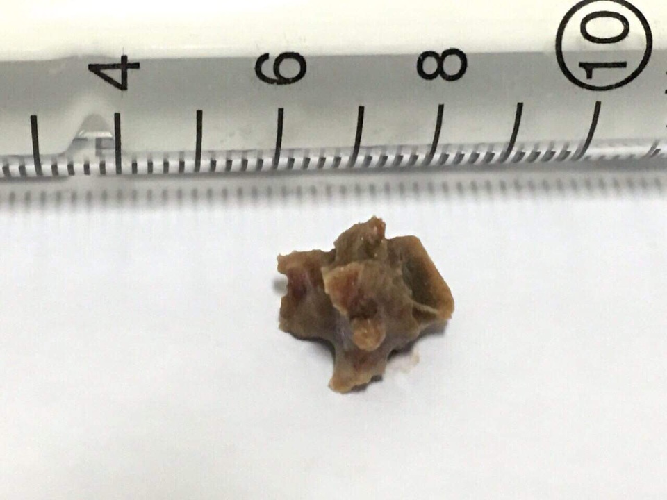 Hy hữu bệnh nhân mắc xương cá 5 năm không biết - 2