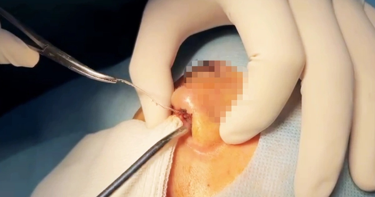 Cô gái 28 tuổi nguy kịch trong lúc phẫu thuật thẩm mỹ nâng mũi ở TPHCM