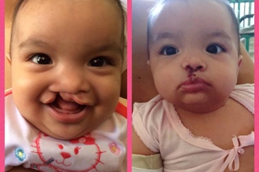 Miễn phí phẫu thuật sứt môi, hở hàm ếch, lệch lỗ tiểu