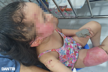 Vụ thai phụ sắp sinh bỏng thương tâm vì nướng mực: Bé 4 tuổi cháy mặt, đùi