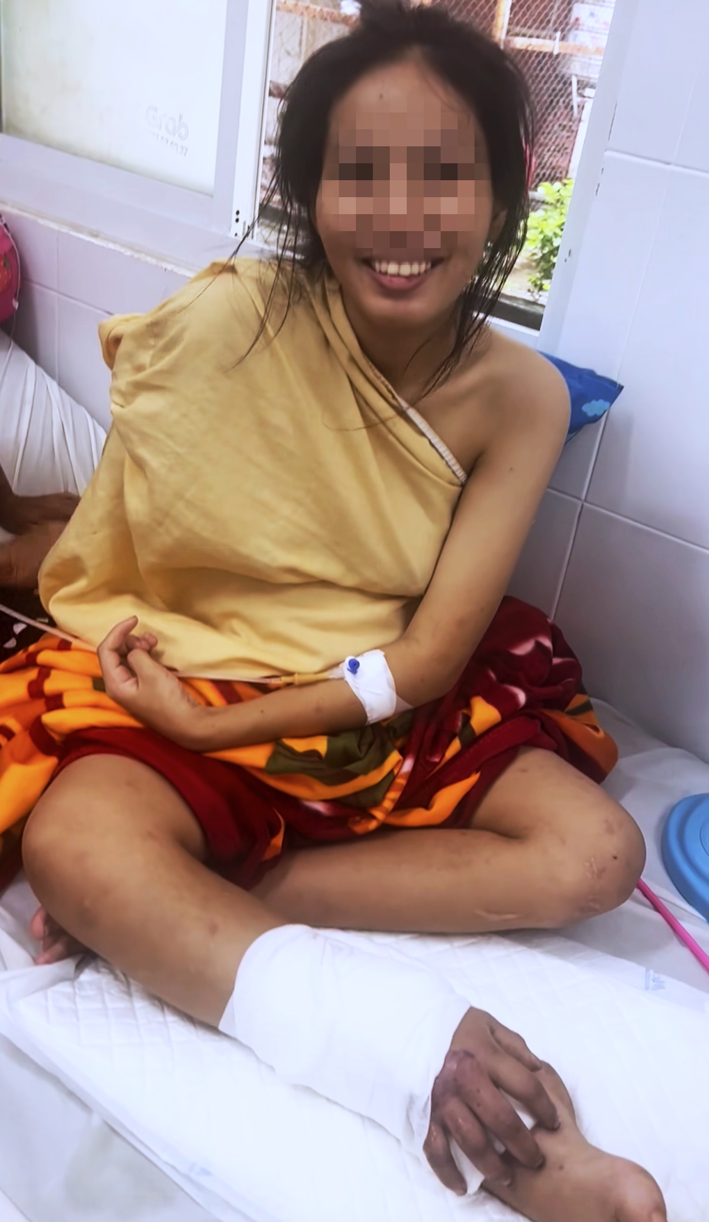 Vì sao bác sĩ phải ghép tạm tay đứt lìa vào chân cô gái mang song thai? - 4 Vì sao bác sĩ phải ghép tạm tay đứt lìa vào chân cô gái mang song thai? - 4