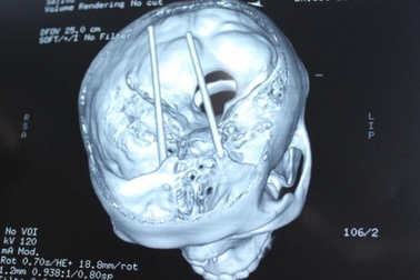 Cứu nam thanh niên bị đôi đũa đâm xuyên não