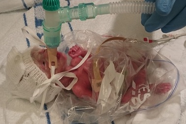 Bé sinh non được ủ ấm bằng… túi nhựa đựng bánh sandwich