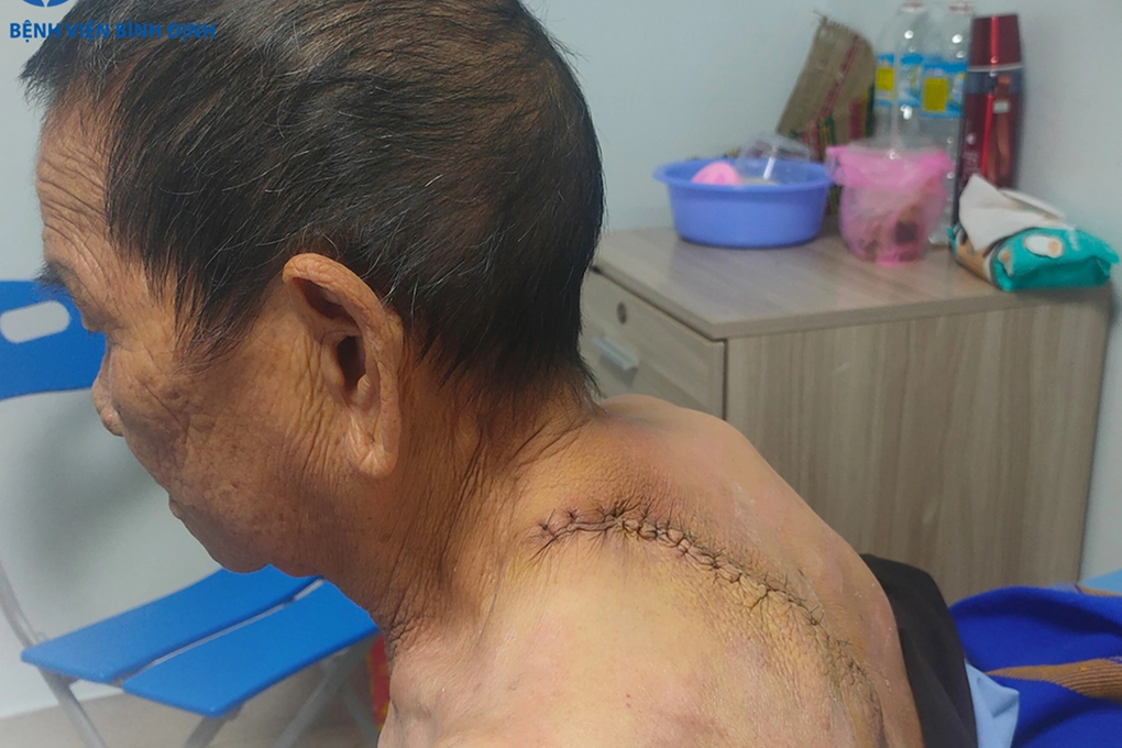 Cụ bà được giải thoát khỏi khối u 5kg mọc trên lưng - 2 Cụ bà được giải thoát khỏi khối u 5kg mọc trên lưng - 2