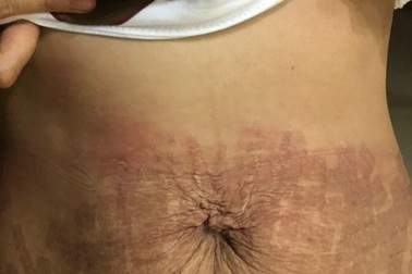 Thẩm mỹ viện “ma” dùng tế bào gốc dỏm làm “cháy” bụng bệnh nhân