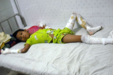 Cháu bé 11 tuổi bị anh họ thiêu cháy