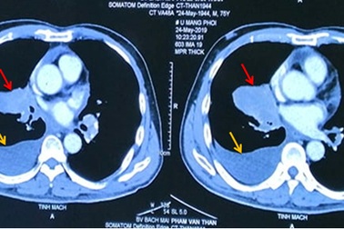 Hút thuốc 25 năm, người đàn ông mắc 2 ung thư cùng lúc di căn não