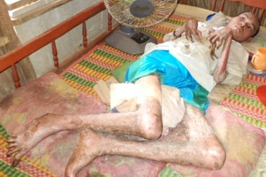 Chàng trai Khmer 7 năm nằm liệt giường với tứ chi biến dạng 