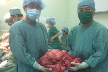 Phẫu thuật khối u hơn 10kg trong bụng bệnh nhân