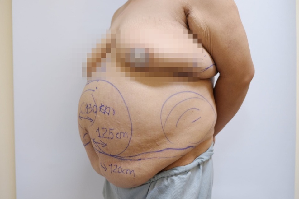 Giải cứu bà mẹ 2 con thừa cả “rổ” mỡ ở bụng, nặng hơn 100 kg - 1 Giải cứu bà mẹ 2 con thừa cả “rổ” mỡ ở bụng, nặng hơn 100 kg - 1