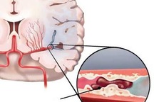 Tại sao người bị đột quỵ nhồi máu não nên dùng Nattospes?