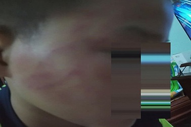 Học sinh lớp 4 bị thầy giáo tát bầm má