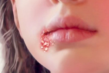 Thiếu nữ 15 tuổi đã mắc sùi mào gà