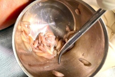 Bác sĩ gắp hơn 100 con giòi làm ổ trong miệng bệnh nhân